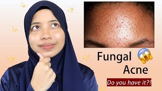 Everything You Need To Know About Fungal Acne [upl. by Ydrah]