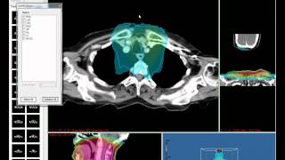 Fratoria Dicom RT Viewer  Part 1 [upl. by Akemehc686]