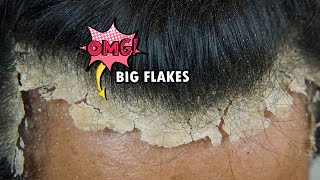 Picking BIG Scalp Flakes Psoriasis Satisfying 745 [upl. by Pachston]