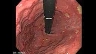 Endoscopy of Multiple Ulcers of the Stomach [upl. by Eitsyrk]