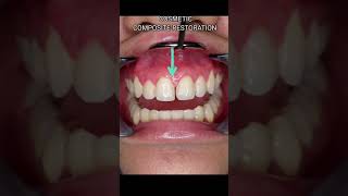 Immediate Fix for GAPS OR SPACES for your front teeth DIASTEMA CLOSURECOSMETIC RESTORATION shorts [upl. by Winslow]