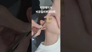 리팟 레이저 다발성 흑자 세종리팟 세종시리팟 reepot lentigo multiplelentigo 청주리팟 공주리팟 대전리팟 오창리팟 오송리팟 부여리팟 [upl. by Slein651]