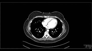 Abdominal Anatomy on Computed Tomography [upl. by Barbe]