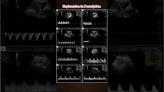 Umbilical Artery Doppler 🫀 medical doppler pregnancy pregnancycare shorts [upl. by Flory]