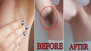 Baking Soda For Dark Spots amp Acne Scars  How to Remove amp Fade Away  DIY [upl. by Enirtak]