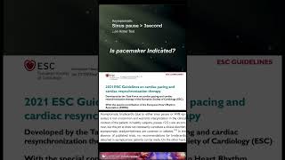 Is Pacemaker Indication for Asymptomatic Sinus Pause echosingh pacemaker sinuspause [upl. by Shamrao]