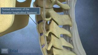 Anterior Subluxation in the Cervical Spine  3D Animation [upl. by Alrrats]