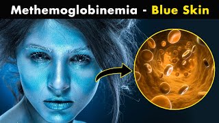 How Methemoglobinemia Effects our body UrduHindi [upl. by Williams]