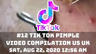 12 TIK TOK PIMPLE VIDEO COMPILATION US UK  22nd August 2020 [upl. by Hamrah32]