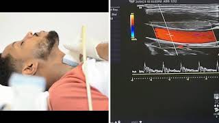 Carotid and Vertebral Arteries Doppler Ultrasound Protocols [upl. by Riggs]