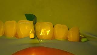 Repairing a Cavity in a Front Tooth [upl. by Bokaj]