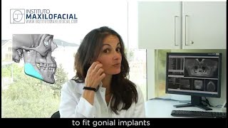 Gonial implants [upl. by Bremer]