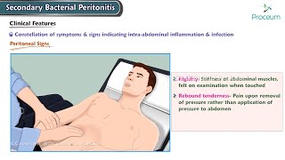 Secondary Bacterial Peritonitis Etiology Clinical features Diagnosis Management Surgery [upl. by Ellenwahs]