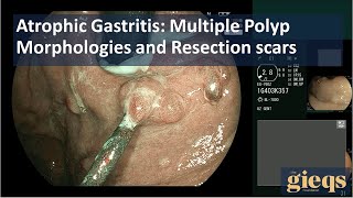 Atrophic Gastritis Multiple Polyp Morphologies and Resection scars [upl. by Hennie383]