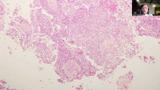 Tip76 NodularAtypical Teratoid Rhabdoid Tumor [upl. by Emmit463]