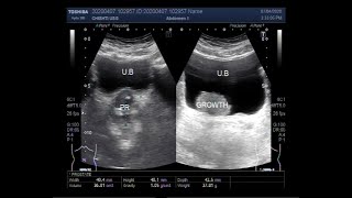 Ultrasound Video showing a Tumor in Urinary Bladder [upl. by Sufur313]