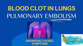 Pulmonary Embolism Blood Clot In Lungs Diagnosis Symptoms amp Causes [upl. by Debarath]