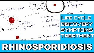 Rhinosporidiosis  Rhinosporidium seeberi  Life cycle  symptoms  Treatment [upl. by Morey912]