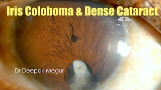 Phaco in a case of Iris Coloboma and Fluid Misdirection Syndrome Dr Deepak Megur [upl. by Liddie]