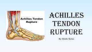 Achilles tendon rupture  clinical feature Simmonds test investigation treatment [upl. by Astrix]