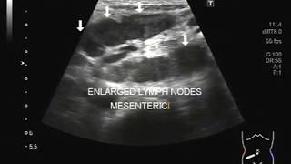 Ultrasound Video showing bilateral enlargement of mesenteric lymph nodes in a Pt aged 10 years [upl. by Ayalahs]