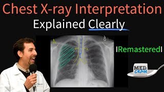 Chest X Ray Interpretation Explained Clearly  How to read a chest Xray [upl. by Aoht348]