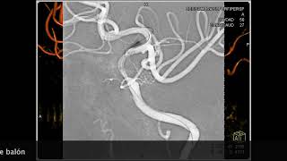 Angioplastia Intracraneal Gateway  Wingspan [upl. by Gefen]