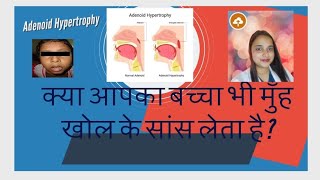 Adenoid Hypertrophy  नाक के पीछे गांठ बच्चों में मुंह खोल के सांस लेना  खराटे बच्चों में [upl. by Lebam893]