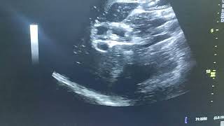 biliary ascaris ultrasound [upl. by Vizza]