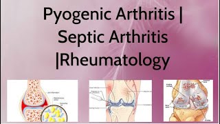 Pyogenic Arthritis  Septic Arthritis Rheumatologyphysio physiotherapy physiotherapist [upl. by Rramed]