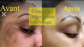 Comment se débarrasser des taches noires du visage rapidement [upl. by Haidabej]