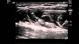 How To UltrasoundGuided Axillary Brachial Plexus Nerve Block Scanning Technique Video [upl. by Wittenburg]