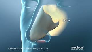 Deviated Septum Surgery Septoplasty for Difficulty in Breathing [upl. by Aimal]