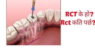 What is rct of teethhow much rct cost How rct is done [upl. by Mozes515]