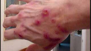 The Morgellons Lesion [upl. by Trumann734]