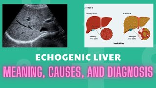 Echogenic Liver Meaning Causes And Diagnosis [upl. by Haman]