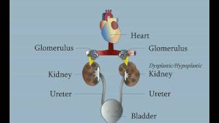 DysplasticHypoplastic Kidneys [upl. by Elmaleh]