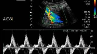 aortic dissection [upl. by Assanav797]