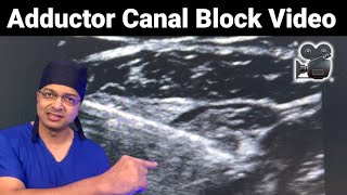 ADDUCTOR CANAL BLOCK Ultrasound Video  Saphenous nerve amp Nerve to Vastus Medialis  NVM Block [upl. by Lenssen]