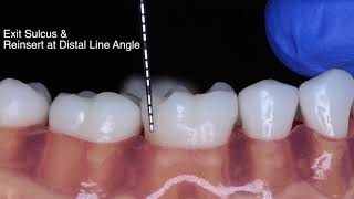 Periodontal Probe Basic Technique [upl. by Nayk]