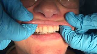 Intraoral Examination [upl. by Gridley]