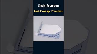 Root coverage procedure for a single recession gingival gumtissue grafting dental [upl. by Myrvyn]