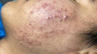 ACNE TREATMENT VU QUYNH MI  Blackheads Of Tweens 2024 EX [upl. by Nylevol]