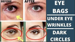 ANTIAGING FACE EXERCISES FOR EYE BAGS EYE WRINKLES DARK CIRCLES amp TIGHTEN DROOPY EYELIDS [upl. by Natfa427]