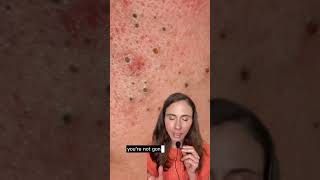 How to remove blackheads dermatologist blackheads blackheadremoval [upl. by Carlos]