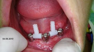 SUBSTITUIÇÃO DE CLIPS EM OVER DENTURE [upl. by Walton]