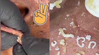 Big Cystic Acne Blackheads Extraction Blackheads amp Milia Whiteheads Removal Pimple Popping [upl. by Bascomb]