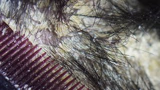 Dandruff scratching removal on head using black combing357 [upl. by Dafna]