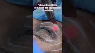 Under Eye Wrinkles Reduction with Fotona SmoothEye [upl. by Lema21]