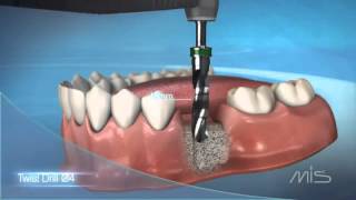 Procedimiento de colocación de implante dental MIS El Salvador [upl. by Nidorf]